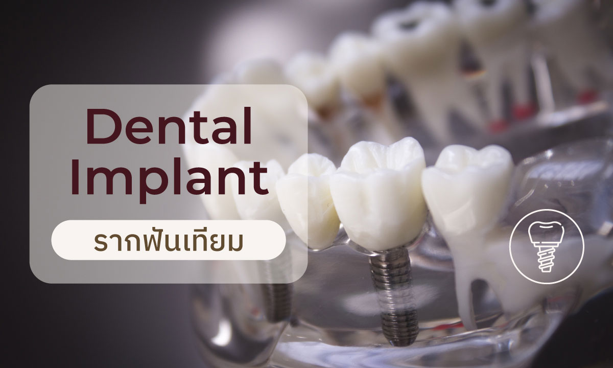 dental_implant_price_start_32999.jpg